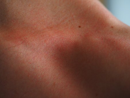 Jak można leczyć atopowe zapalenie skóry